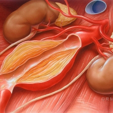 Abdominal Aortic Aneurysm