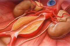 Abdominal Aortic Aneurysm