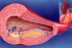 Coronary Atherosclerosis