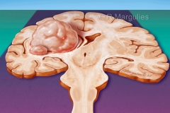 Glioblastoma