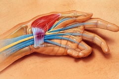 Carpal Tunnel Syndrome