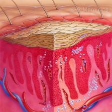 Psoriasis