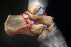 Heel Bone Fracture & X-ray