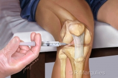 Knee Injection