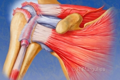 Shoulder Rotator Cuff Tear