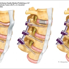 Spine Surgery