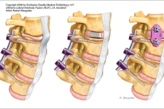 Spine Surgery