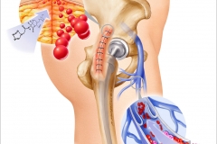 Total Hip Arthroplasty